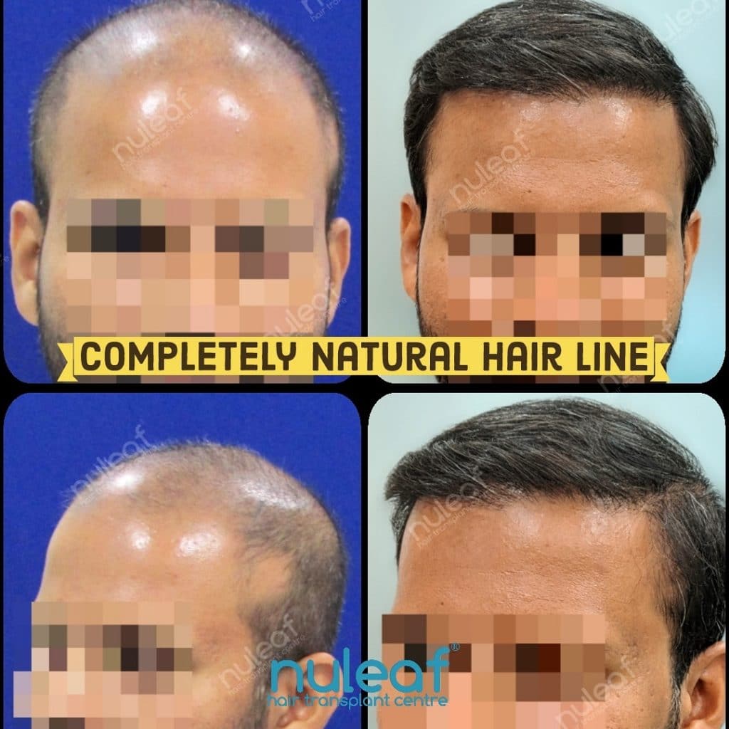 Hair Transplant Results in Pune