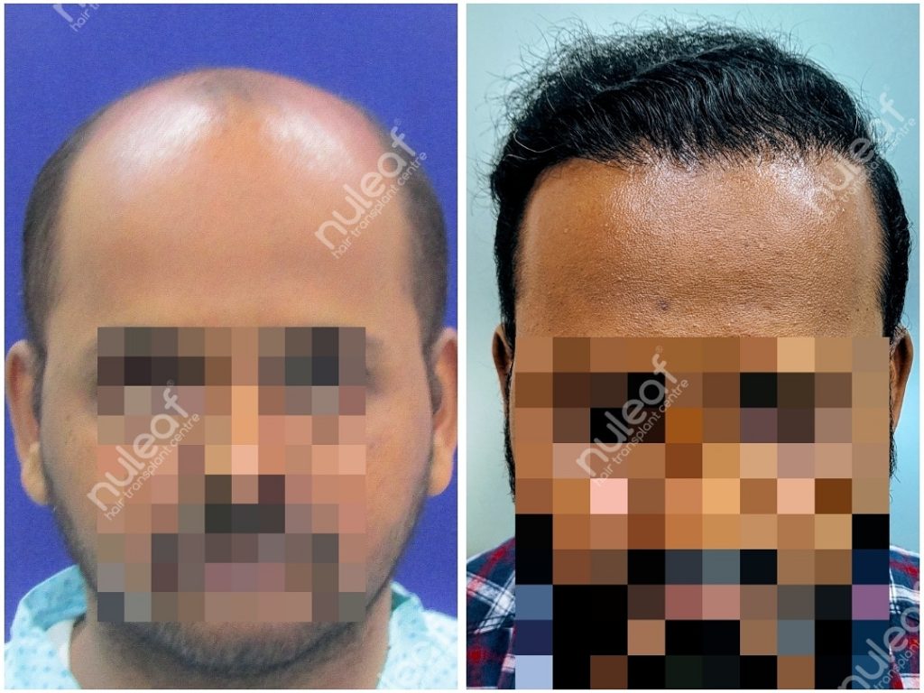 Hair Transplant Results in Pune