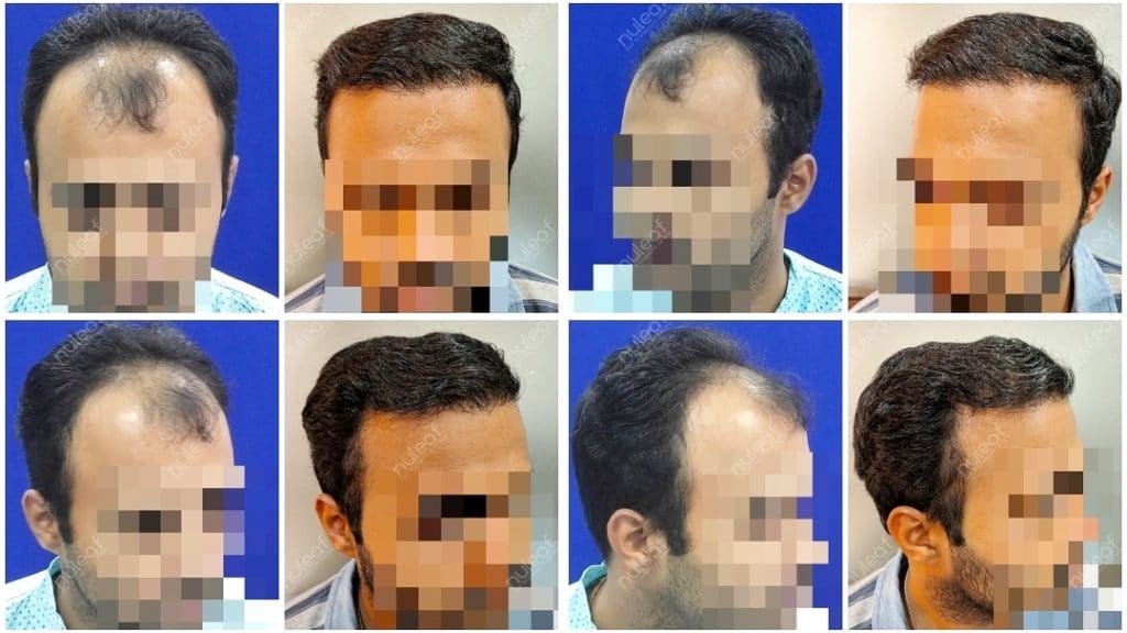 Hair Transplant Results in Pune